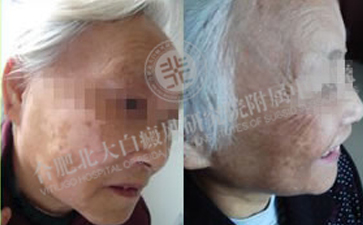 眼部白癜风难治吗、眼部白癜风怎么治