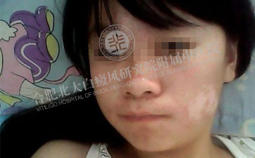 让媛媛的青春更圆满、女性白癜风治疗去哪里