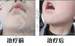 7岁挑食儿童遇见“白癜风”、儿童白癜风应该引起父母重视