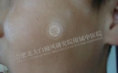 面部白癜风