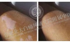 四肢白癜风